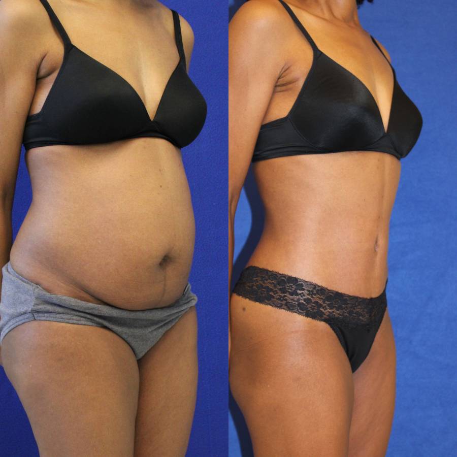 Mini Tuck And Tummy Tuck (abdominoplasty) Before & After Photos Patient 06