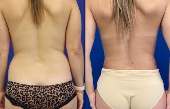 before/after