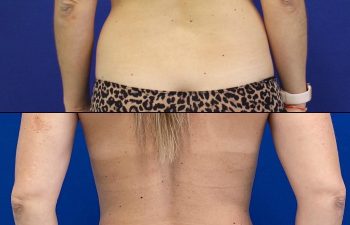 before/after