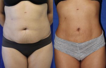 before/after