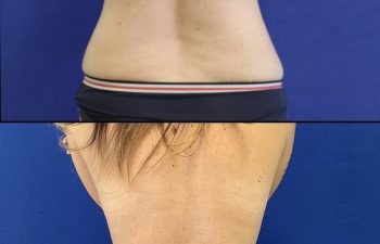 44 year-old before and after flanks liposuction