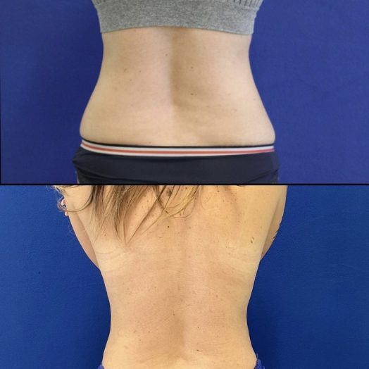 44 year-old before and after flanks liposuction