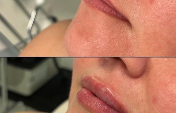 patient before and after lip filler