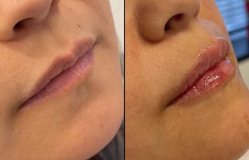 patient before and after lip filler