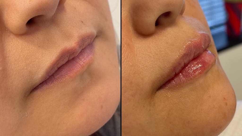 patient before and after lip filler