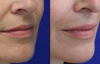 patient before and after lip filler