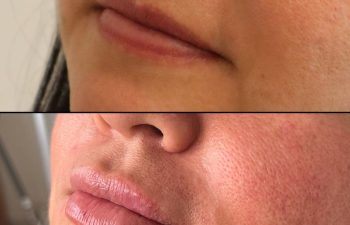 patient before and after lip filler