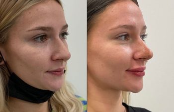patient before and after lip filler