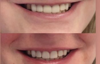 patient before and after lip filler