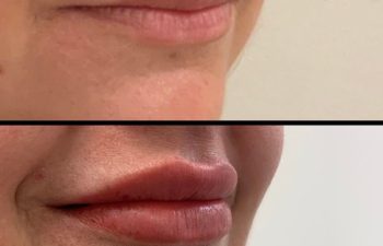 patient before and after lip filler