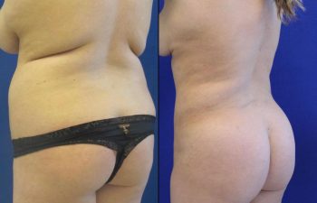 23 year-old before and after liposuction of the abdomen, flanks and Fat transfer to the buttocks (BBL)