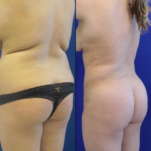 23 year-old before and after liposuction of the abdomen, flanks and Fat transfer to the buttocks (BBL)