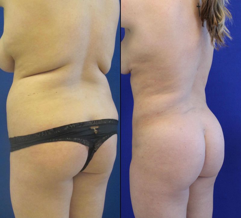 23 year-old before and after liposuction of the abdomen, flanks and Fat transfer to the buttocks (BBL)