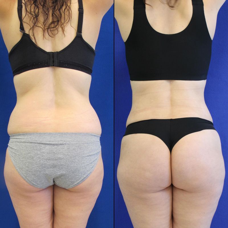 42 year old patient before and after lower back liposuction, flanks liposuction and fat transfer to the buttocks ( BBL)