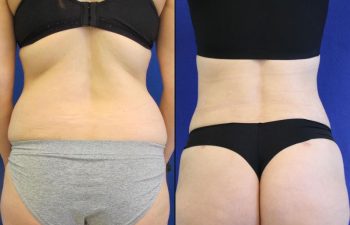 42 year old patient before and after lower back liposuction, flanks liposuction and fat transfer to the buttocks ( BBL)