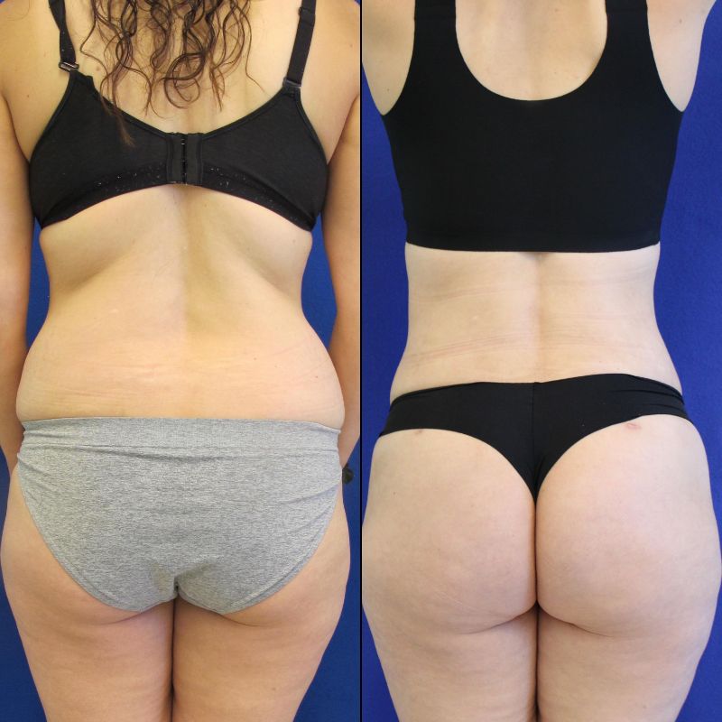 Flank, Back, and Waist Liposuction