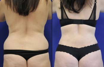 Patient before and after flanks liposuction, lower back liposuction and fat transfer to the buttocks ( BBL)
