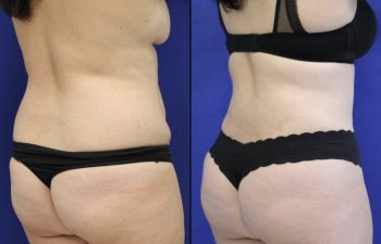 Patient before and after flanks liposuction, lower back liposuction and fat transfer to the buttocks ( BBL)