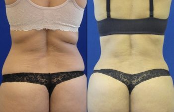44 year old patient before and after flanks liposuction and lower back liposuction