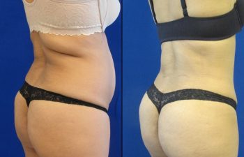 44 year old patient before and after flanks liposuction and lower back liposuction