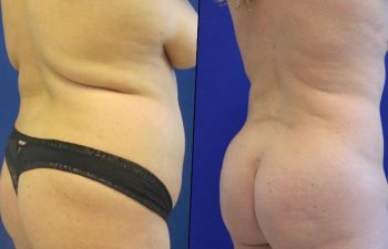 23 year-old before and after liposuction of the abdomen, flanks and Fat transfer to the buttocks (BBL)
