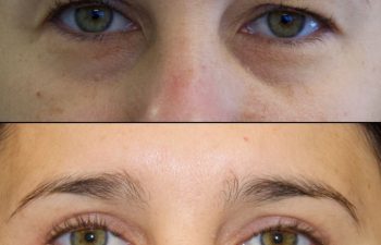 39 year old patient before and after upper blepharoplasty