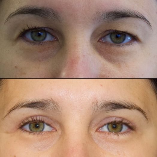 39 year old patient before and after upper blepharoplasty