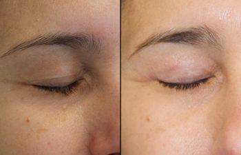 39 year old patient before and after upper blepharoplasty