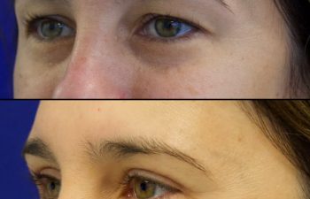 39 year old patient before and after upper blepharoplasty