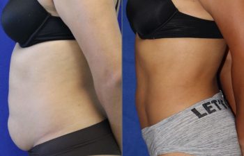 29 year-old patient before and after liposuction of the abdomen and flanks