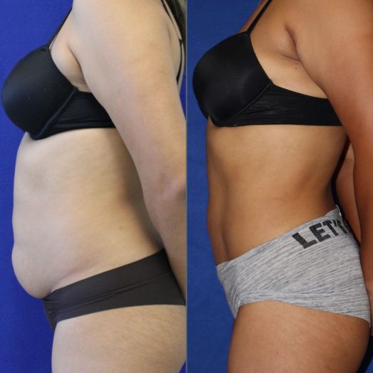 29 year-old patient before and after liposuction of the abdomen and flanks