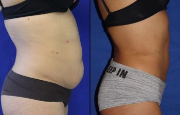 29 year-old patient before and after liposuction of the abdomen and flanks