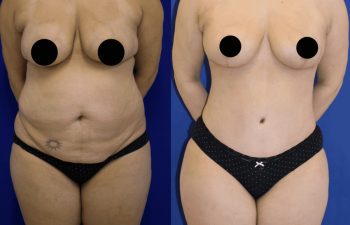 patient before and after tummy tuck