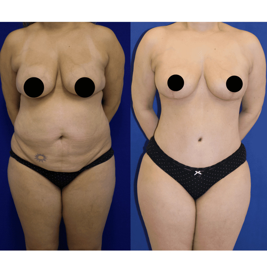 patient before and after tummy tuck