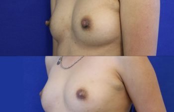 patient before and after nipple reduction