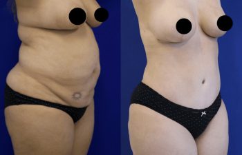 patient before and after tummy tuck