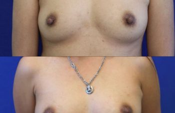 patient before and after nipple reduction