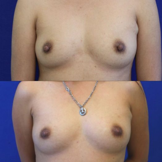 patient before and after nipple reduction