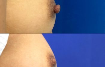 patient before and after nipple reduction