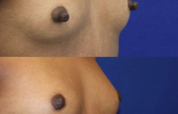 patient before and after nipple reduction