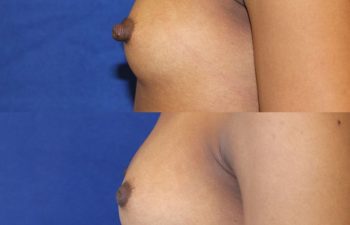 patient before and after nipple reduction
