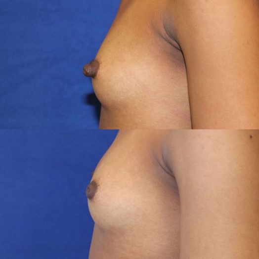 patient before and after nipple reduction