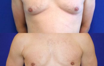 patient before and after Gynecomastia