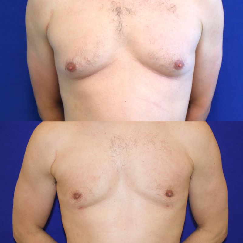 patient before and after Gynecomastia