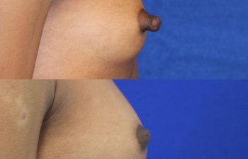 patient before and after nipple reduction