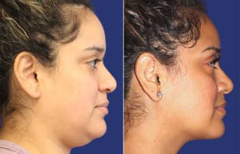 30 year-old patient before and after neck liposuction