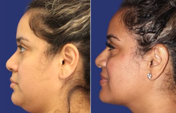 30 year-old patient before and after neck liposuction