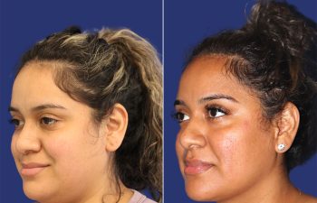 30 year-old patient before and after neck liposuction