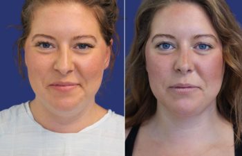 34 year-old patient before and after neck liposuction