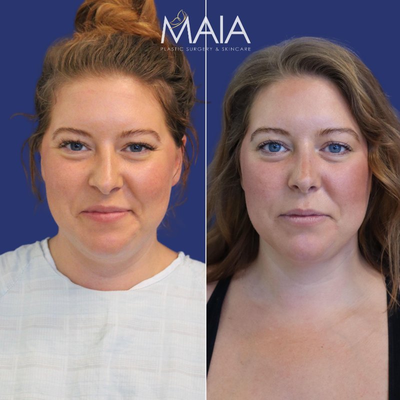 🥇 Liposuction  Maia Plastic Surgery